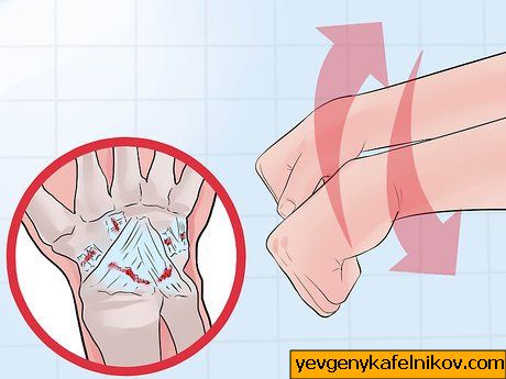 손목 염좌와 손목 골절의 차이를 구분하는 방법